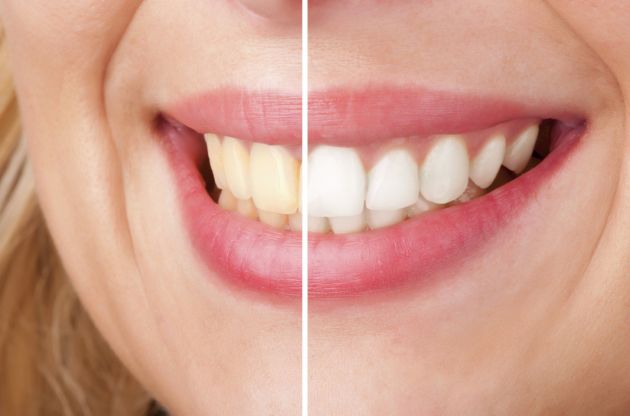 Aprenda como clarear os dentes naturalmente