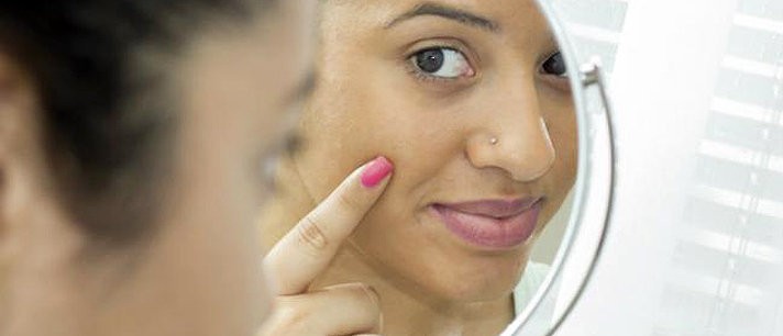 Dicas simples para tratar a acne hormonal