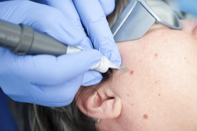 5 tratamentos de pele com laser que você precisa saber