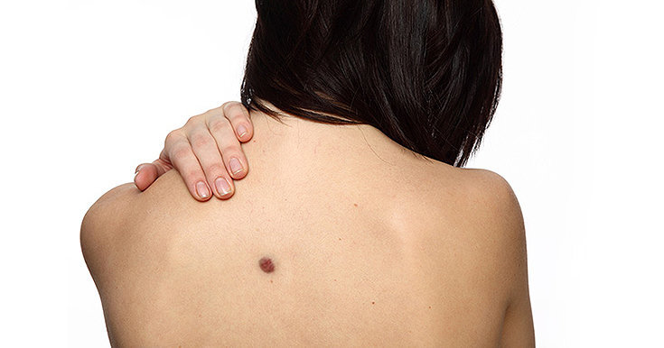 Câncer de pele: causas, sintomas, prevenção e tratamentos!