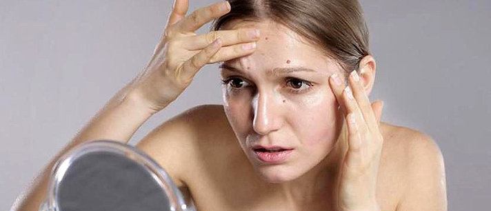 Aprenda como acabar com a acne