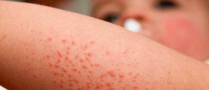 Combata a dermatite atópica infantil com remédios naturais
