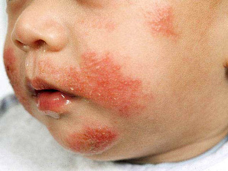 Combata a dermatite atópica infantil com remédios naturais