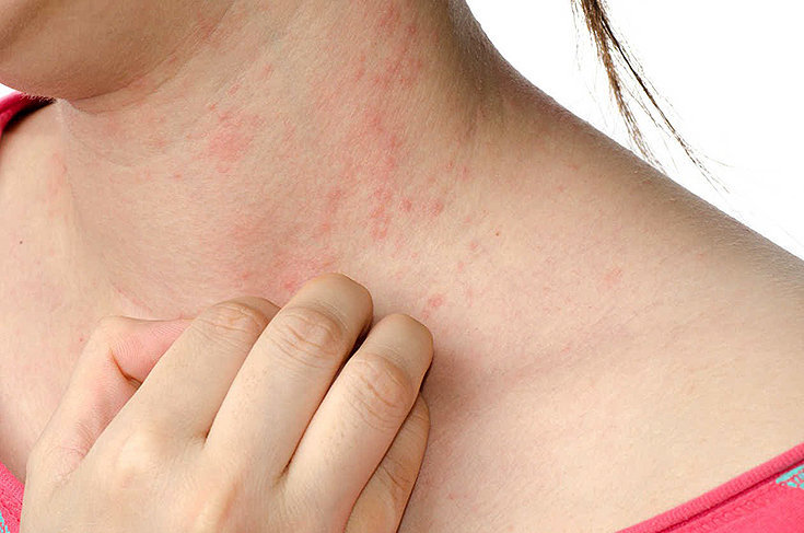 As 10 alergia na pele mais comum