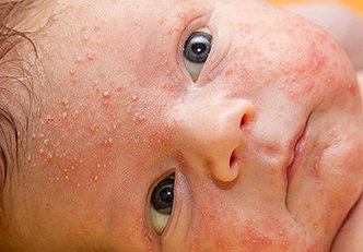 Dermatite atópica no bebê: causas e soluções!!!