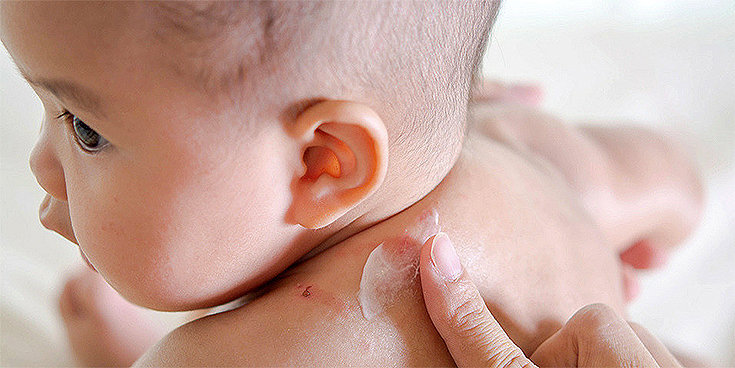 Dermatite atópica no bebê: causas e soluções!!!