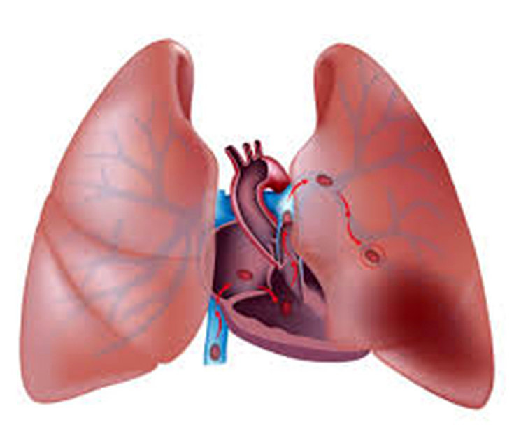 Embolia pulmonar: sintomas, causas, tratamentos e mais!