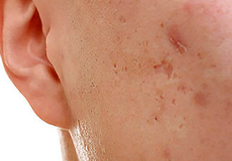 Tratamento para cicatrizes de acne