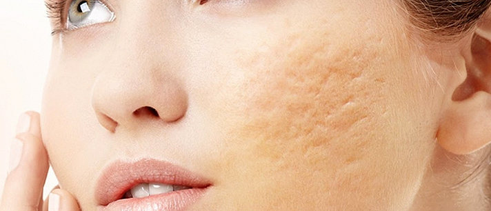 7 remédios caseiros para eliminar as cicatrizes de acne