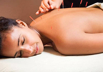 9 surpreendentes benefícios da acupuntura!