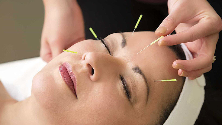 9 surpreendentes benefícios da acupuntura!
